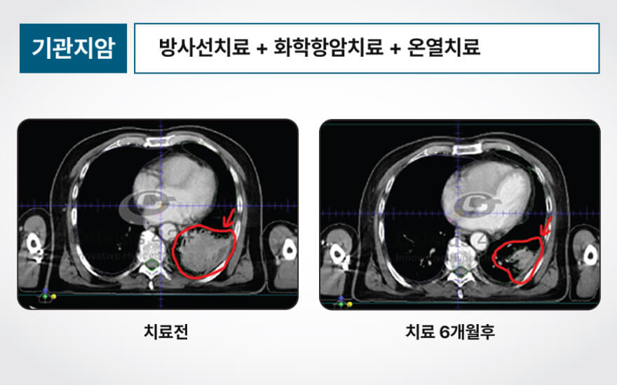 기관지암 : 방사선치료 + 화학항암치료 + 온열치료