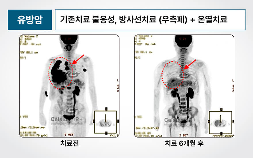 온열치료+방사선의 효과 전후 비교사진