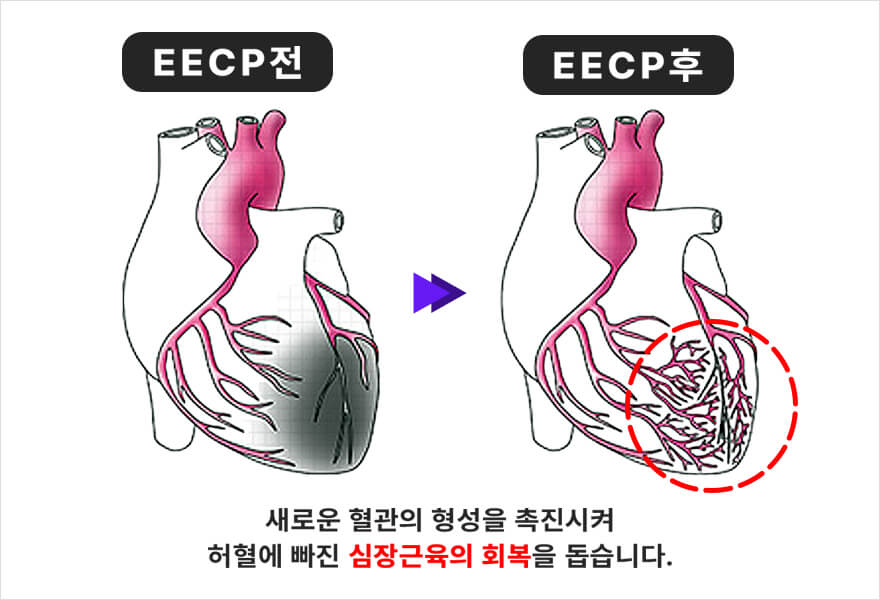 혈류증강치료